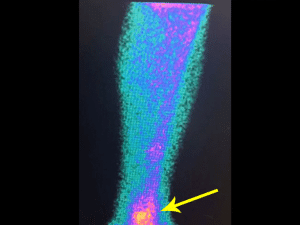 Osteoma Osteóide e Corpo Estranho