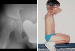 Fraturas Patológicas em Crianças