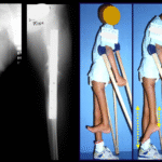 Giroplastia de Van Ness