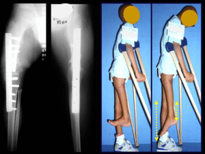 Giroplastia de Van Ness