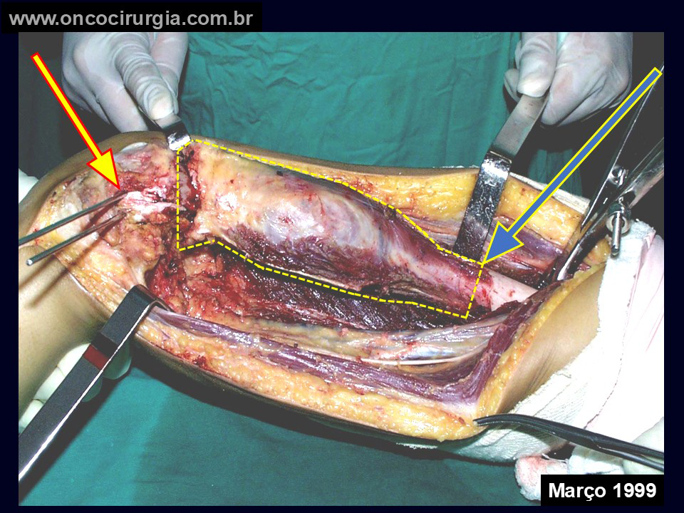 Reconstruções Ósseas Biológicas parte II