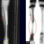 Reconstruções Ósseas Biológicas parte IIII