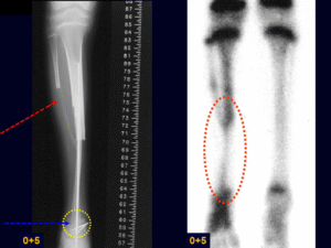 Reconstruções Ósseas Biológicas parte IIII