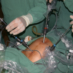 Sacrectomia total sem reconstrução – Parte II